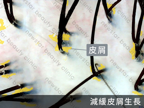 養育髮治療_案例