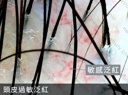 養育髮治療_案例