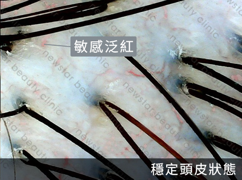 養育髮治療_案例