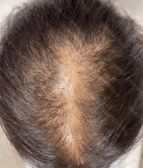 養育髮治療_PRP案例