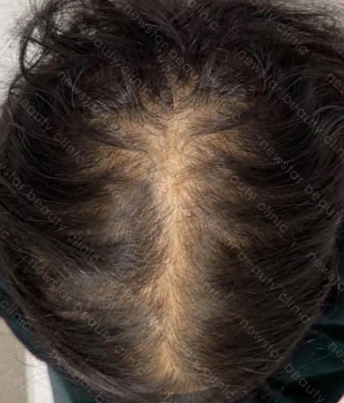 養育髮治療_PRP案例