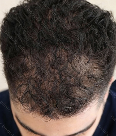 養育髮治療_PRP案例