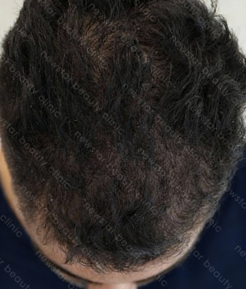 養育髮治療_PRP案例