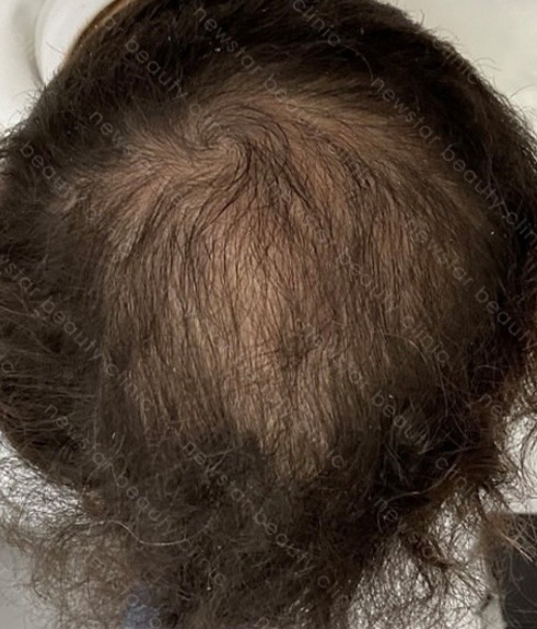 養育髮治療_PRP案例