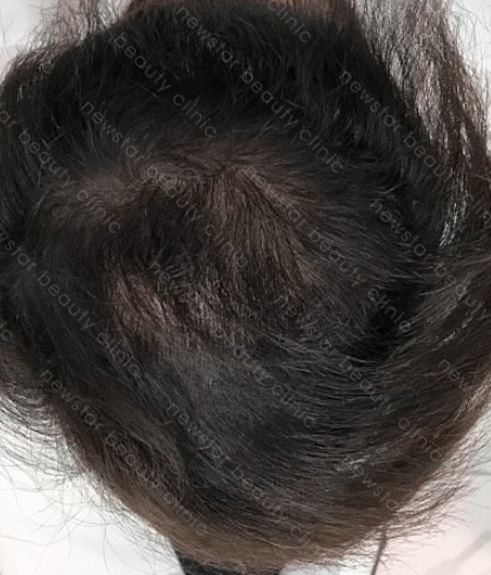 養育髮治療_PRP案例