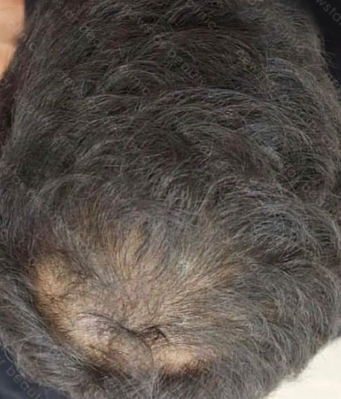 養育髮治療_PRP案例