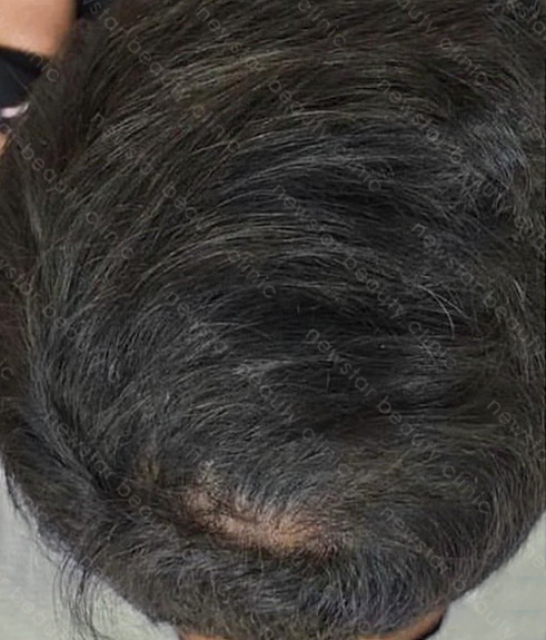 養育髮治療_PRP案例