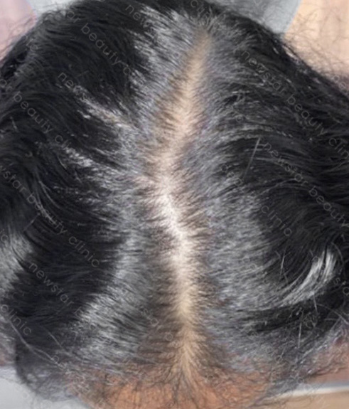 養育髮治療_PRP案例