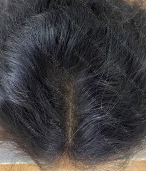 養育髮治療_PRP案例