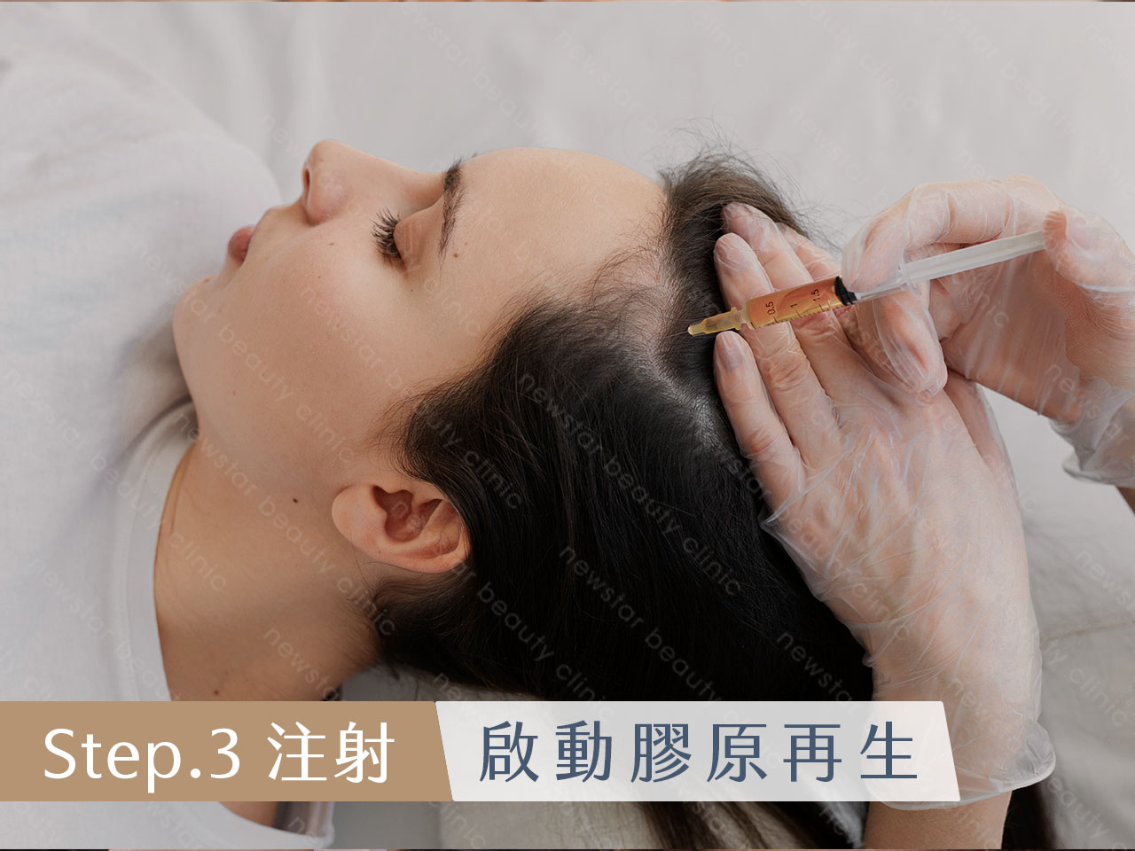 養育髮治療_PRP自體育髮注射_啟動膠原再生