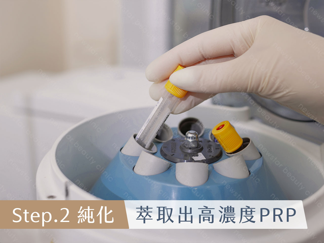 養育髮治療_PRP自體育髮注射_萃取出高濃度PRP
