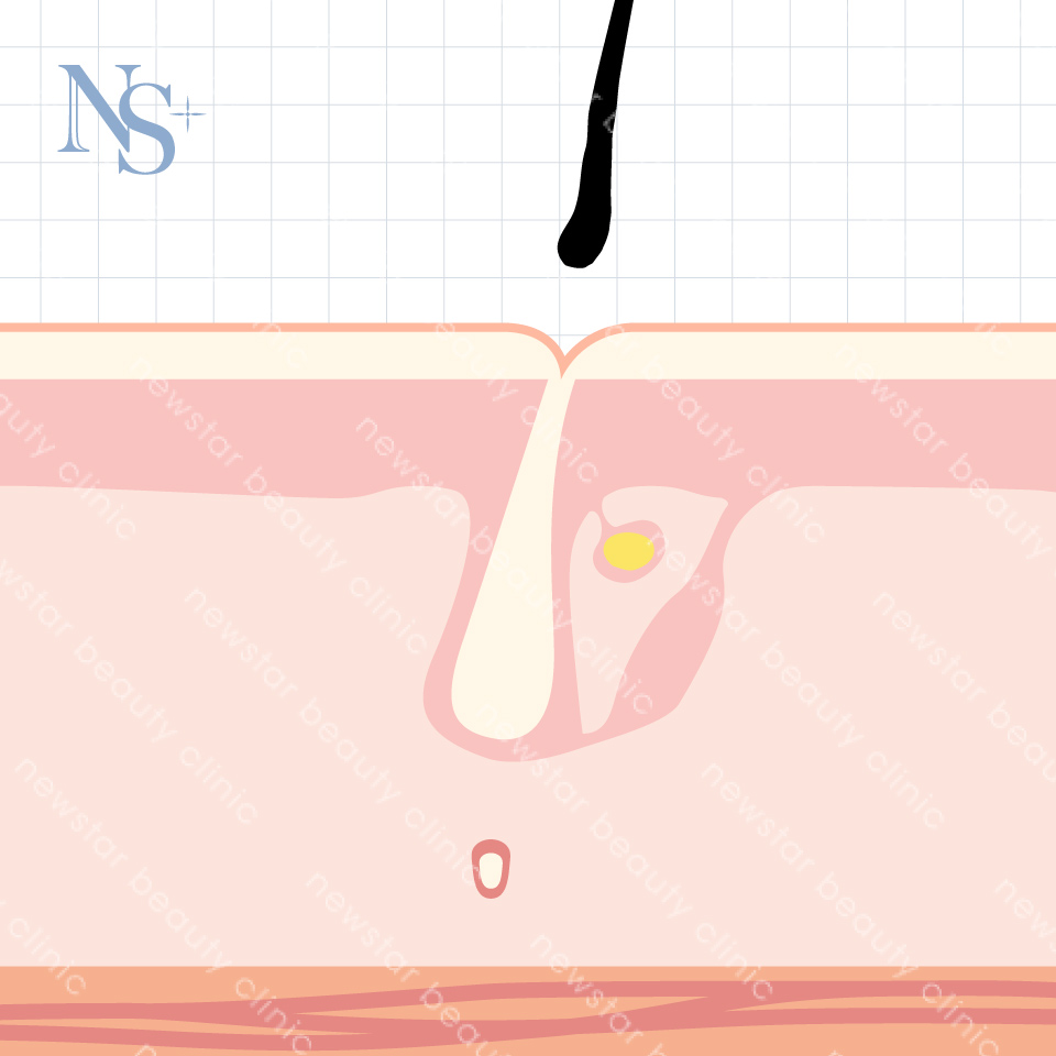 養育髮治療_休止期