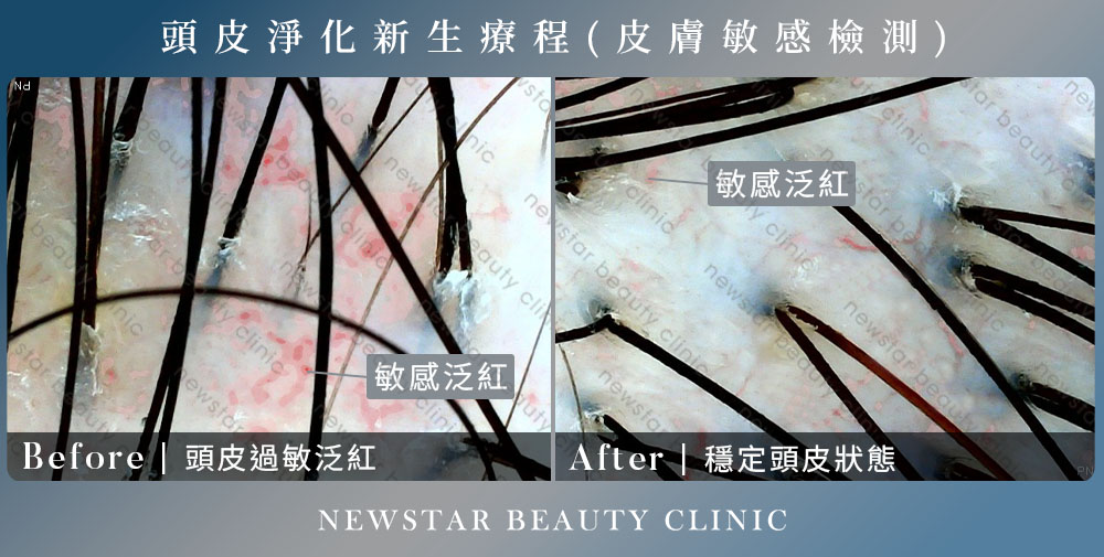 養育髮治療_敏感案例