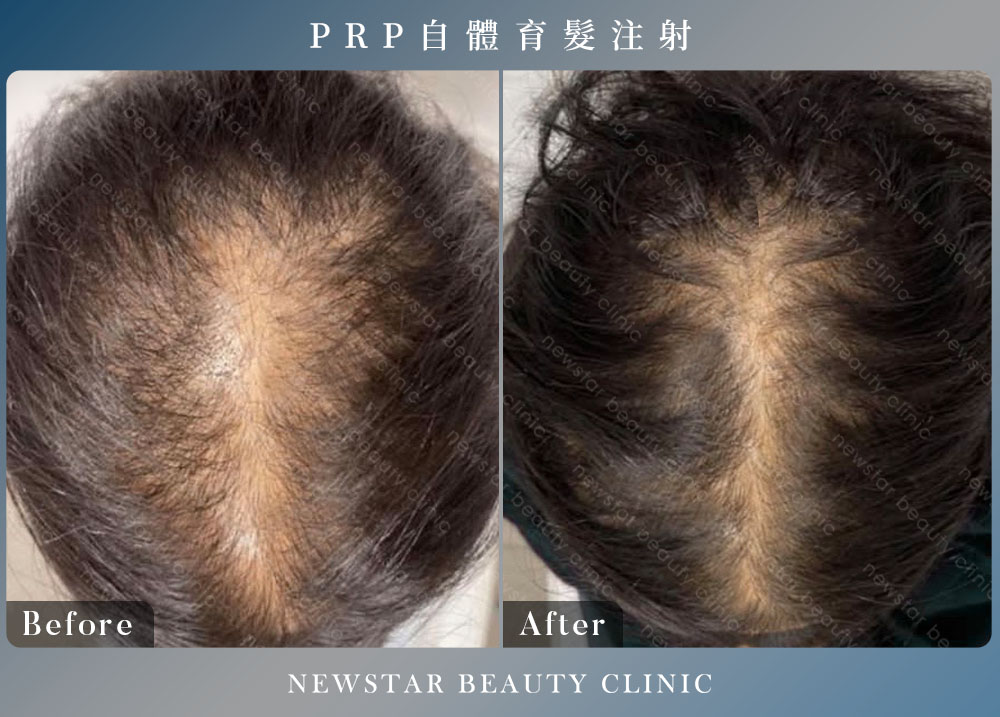 養育髮治療_案例