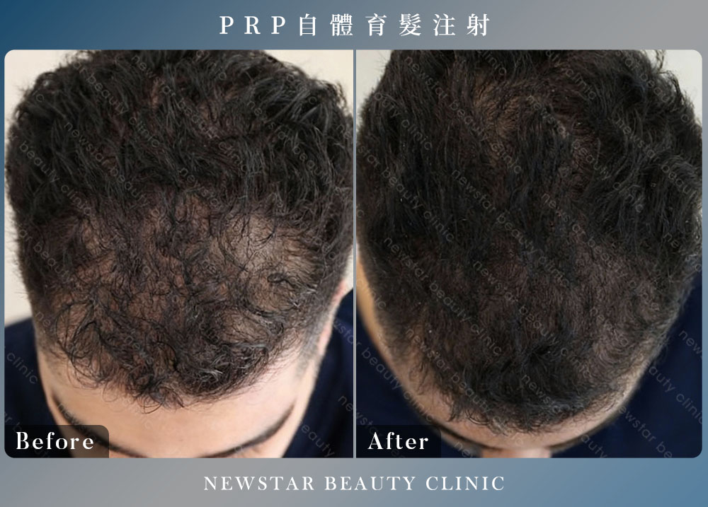 養育髮治療_案例