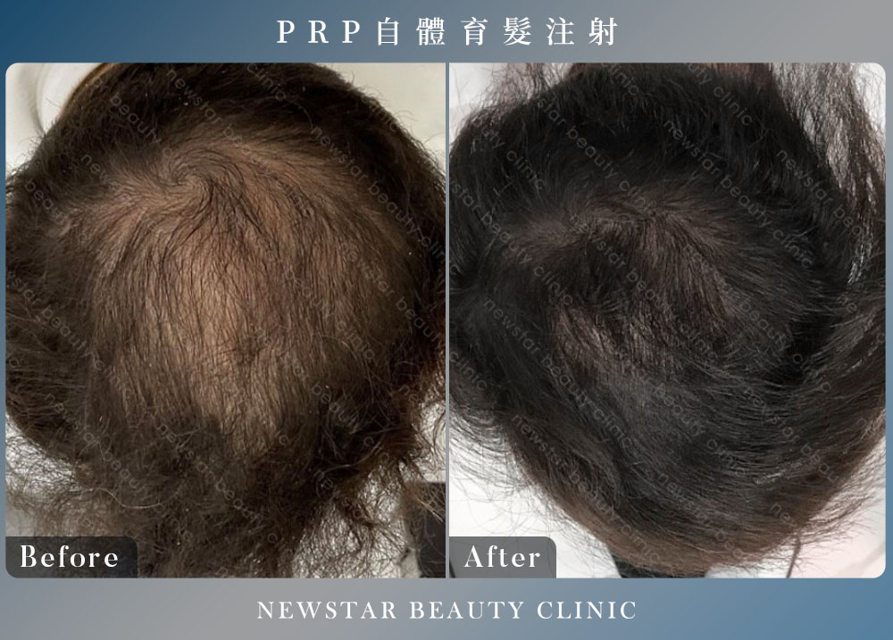 養育髮治療_案例