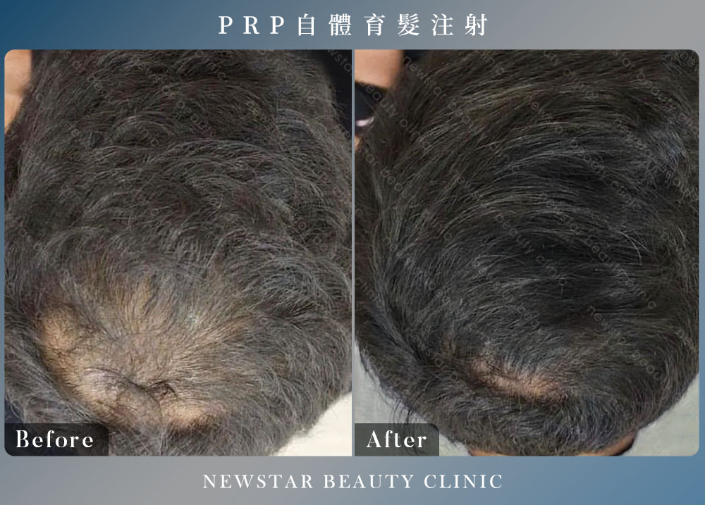 養育髮治療_案例