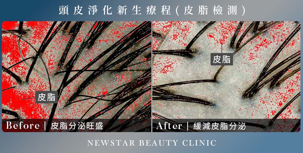 養育髮治療_皮脂2案例