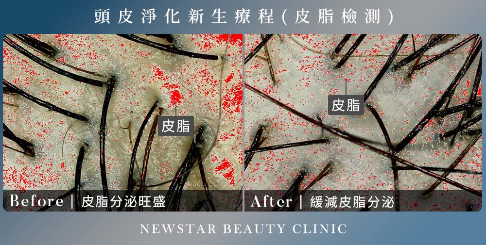 養育髮治療_皮脂案例