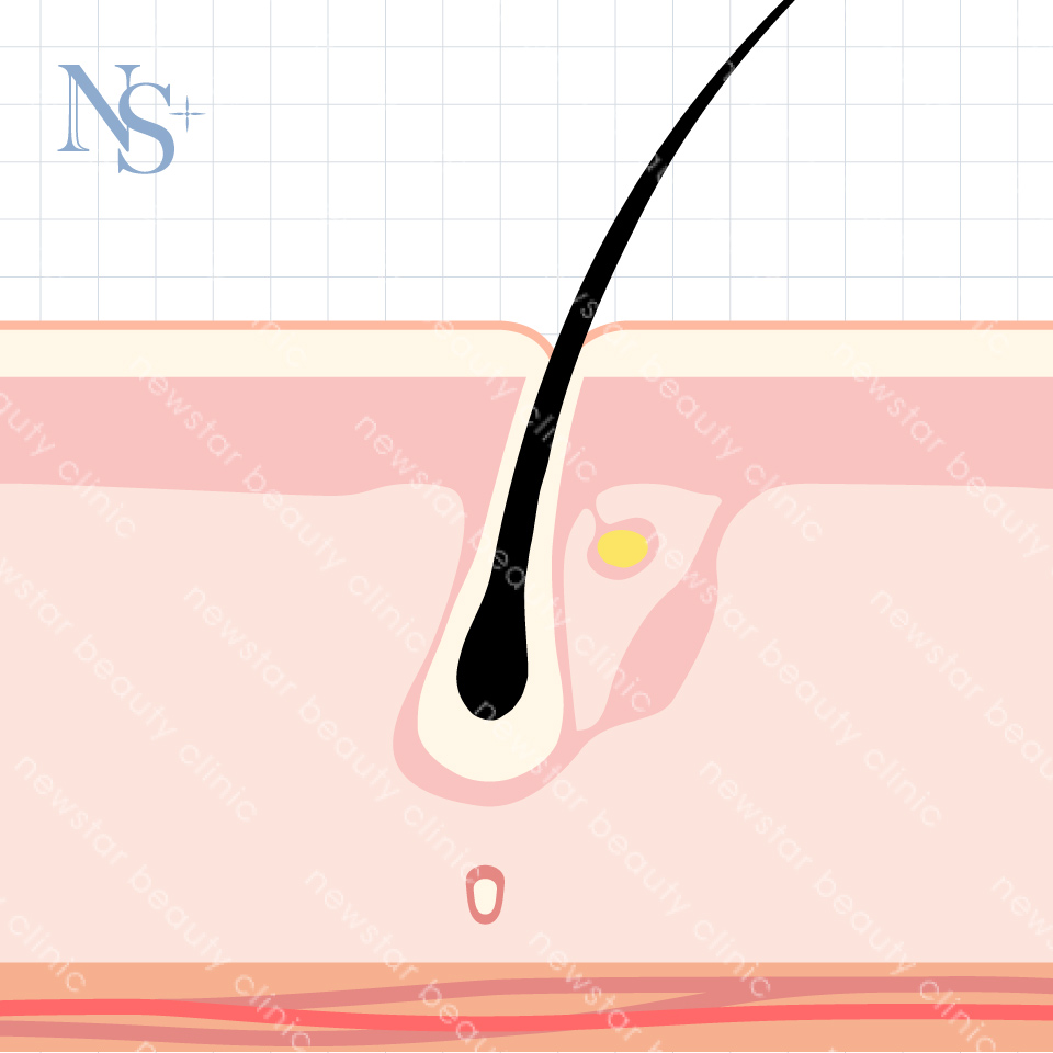 養育髮治療_衰退期