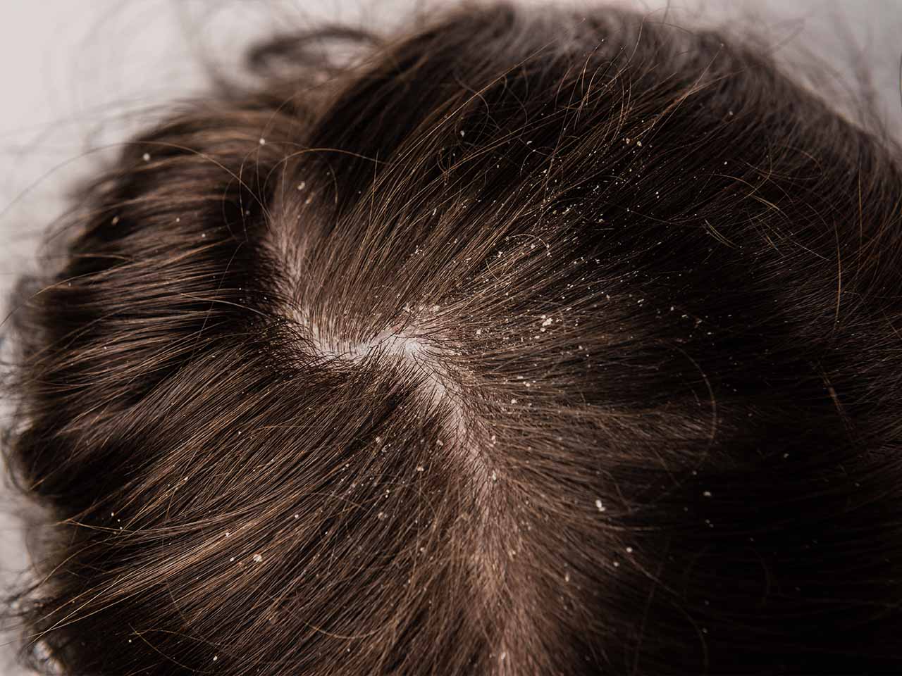 養育髮治療_頭皮屑