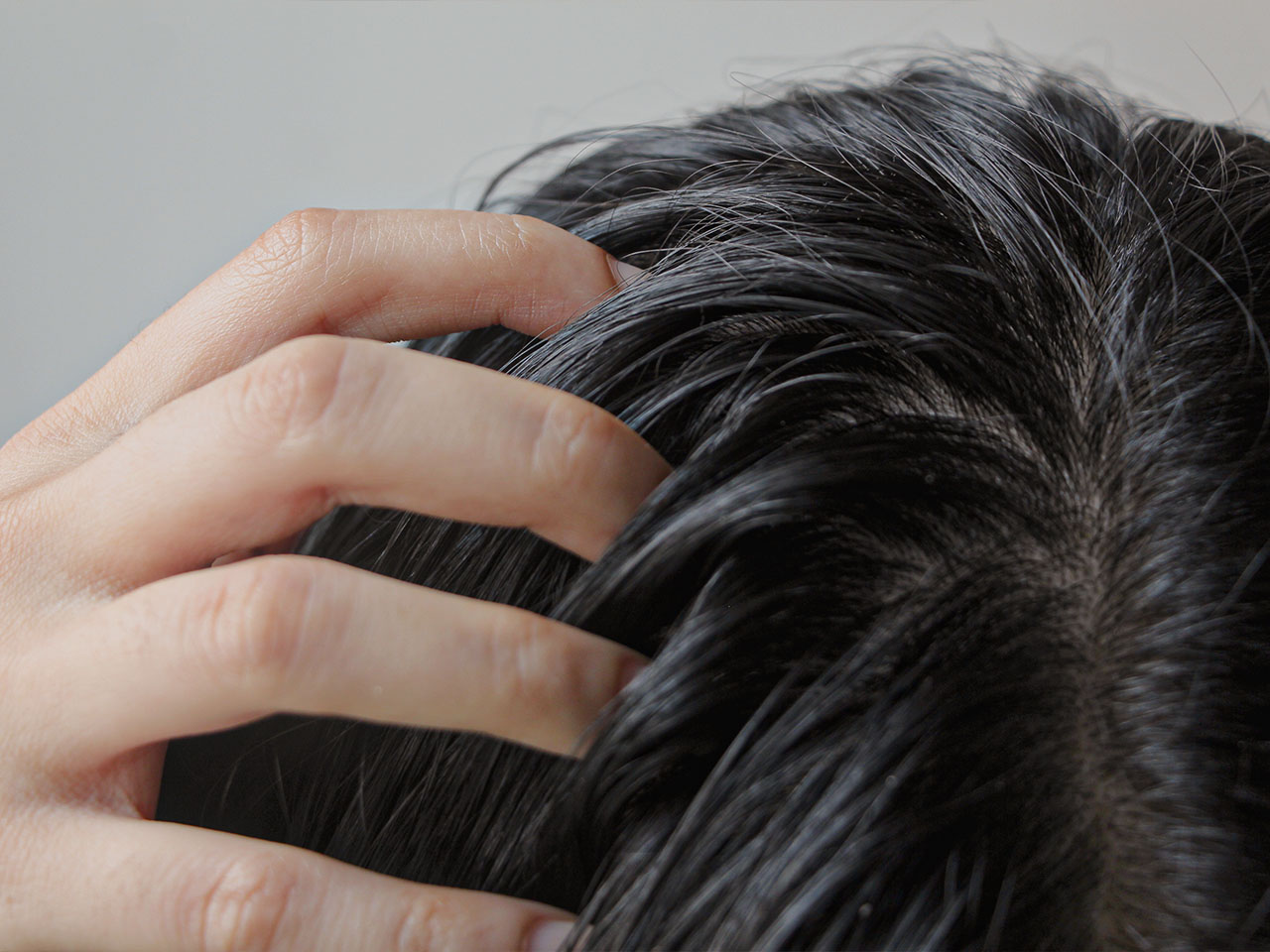 養育髮治療_頭髮出油