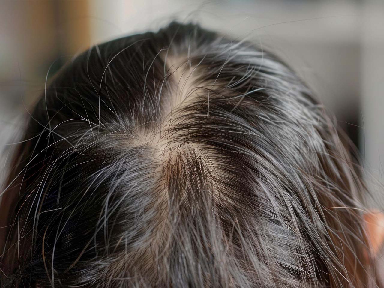 養育髮治療_頭髮稀疏