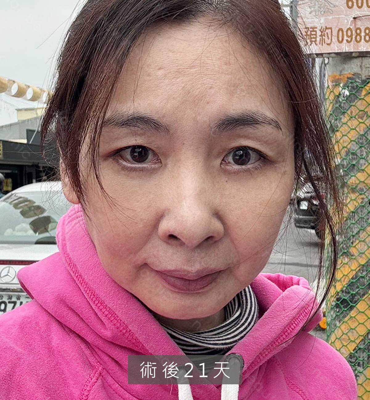 眼袋案例_術後21天