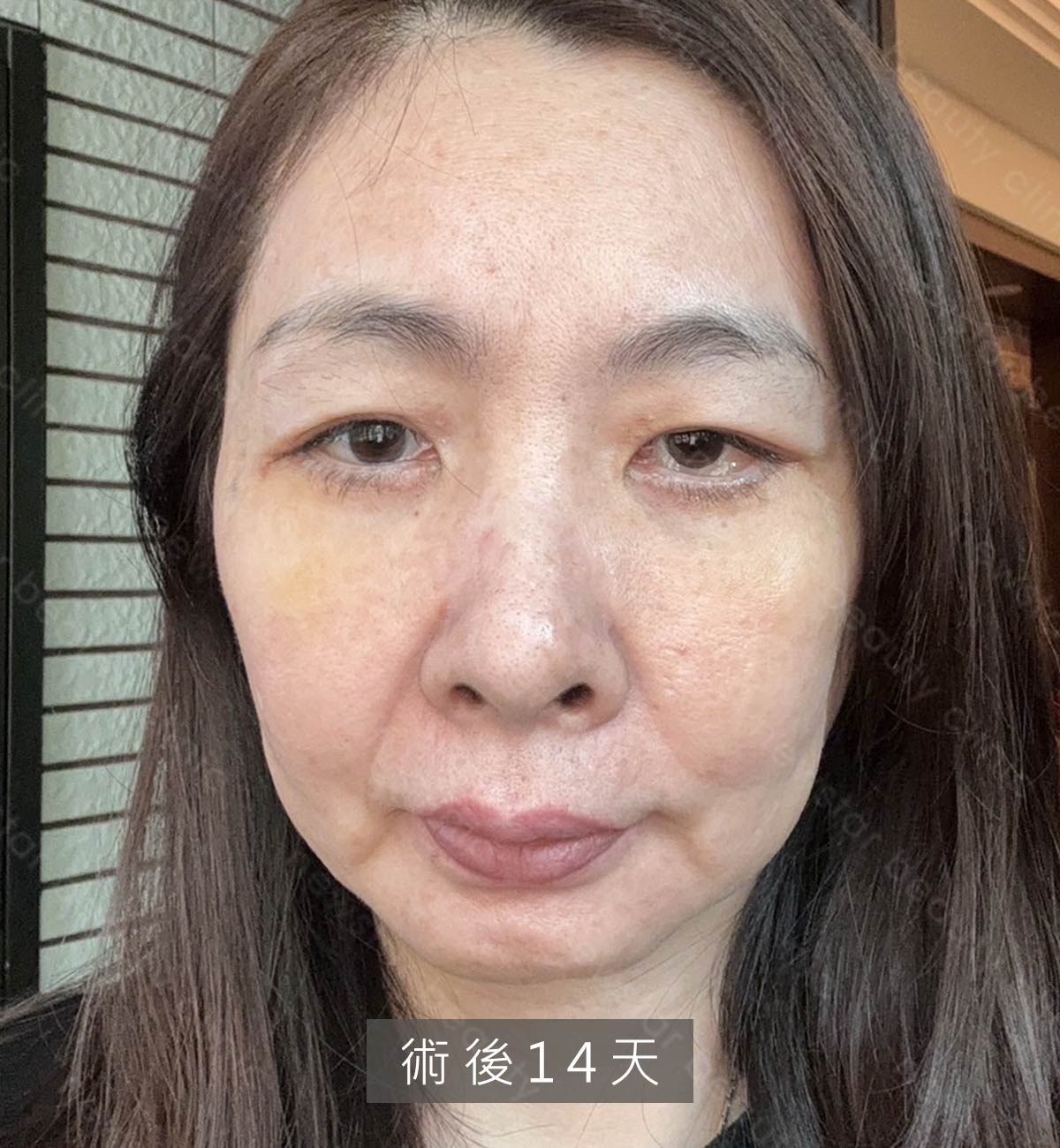 眼袋案例_術後14天