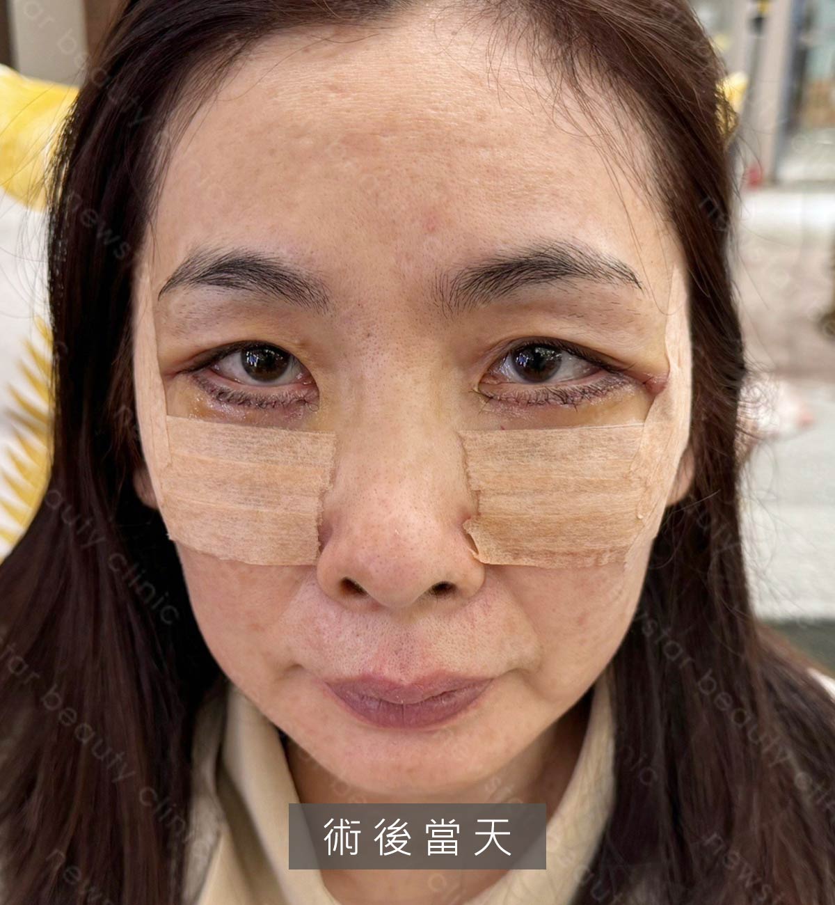 眼袋案例_術後第一天