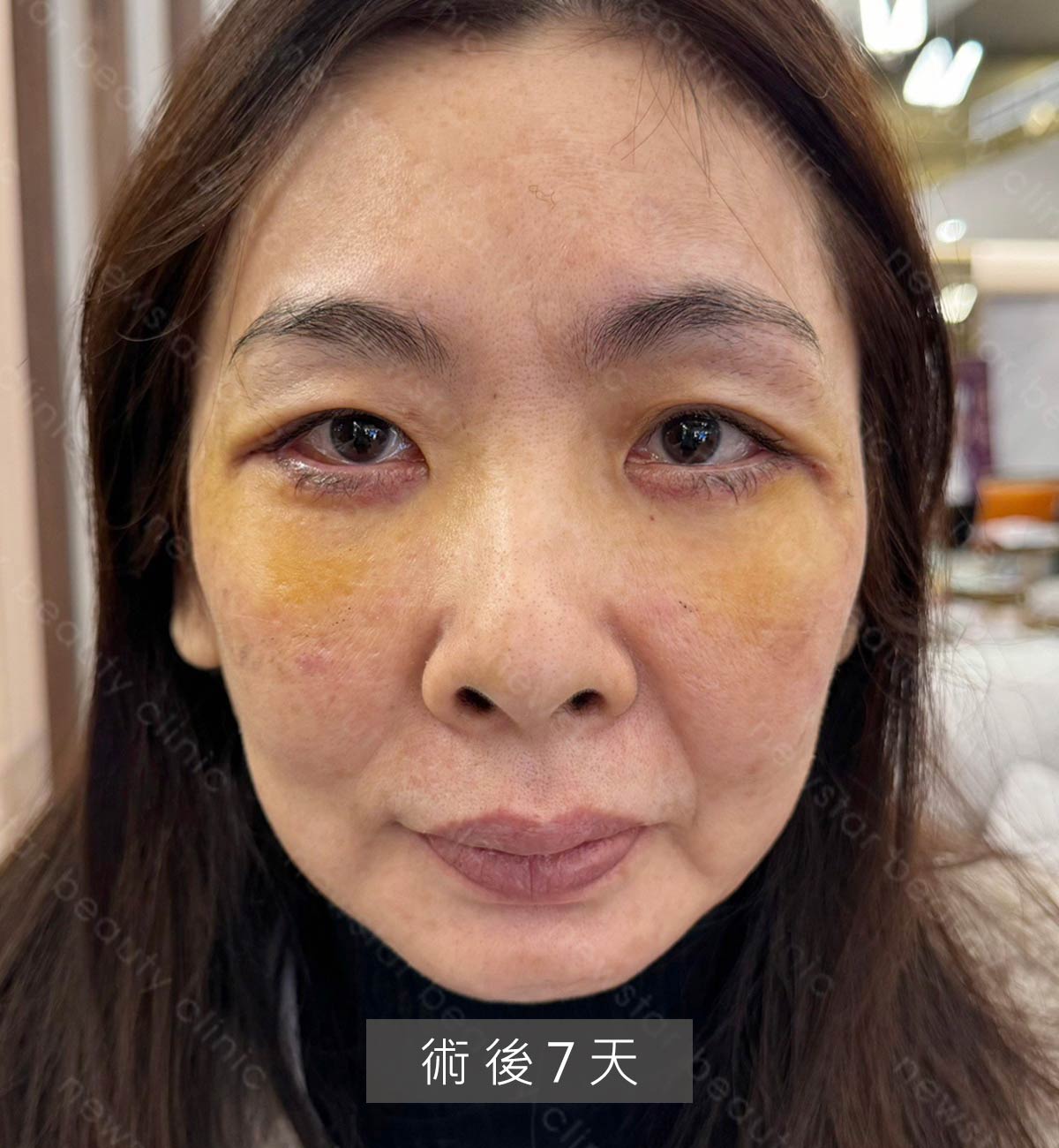 眼袋案例_術後第七天