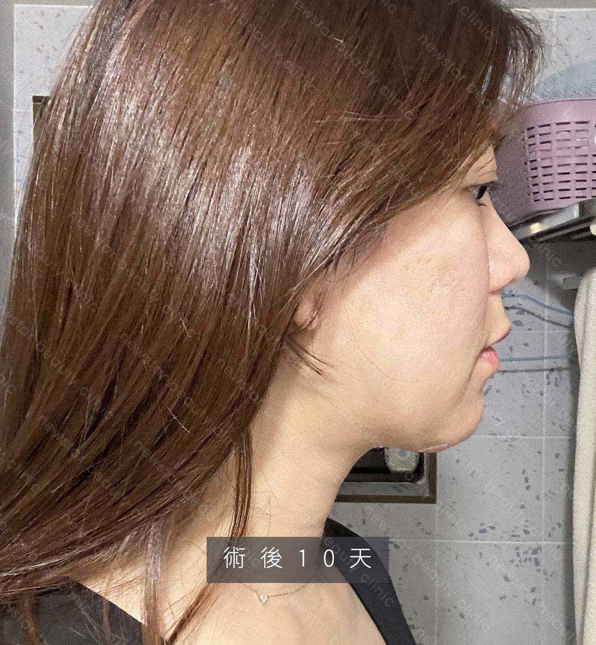 天鵝頸手術_術後生活恢復_10天