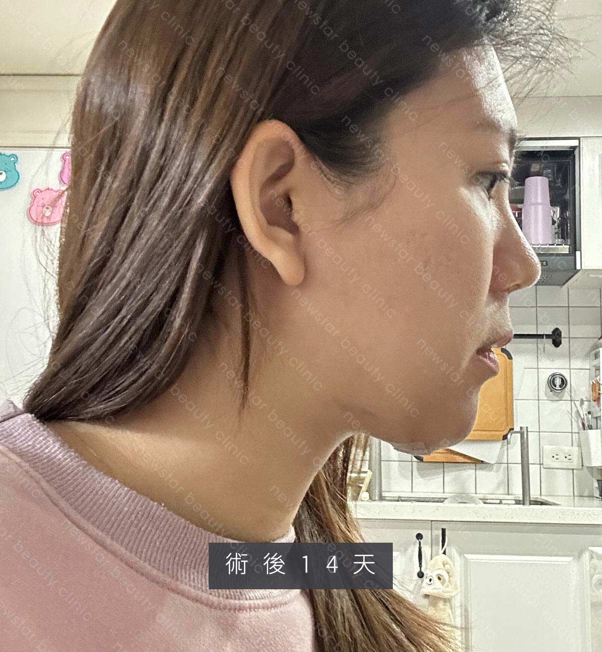 天鵝頸手術_術後生活恢復_14天