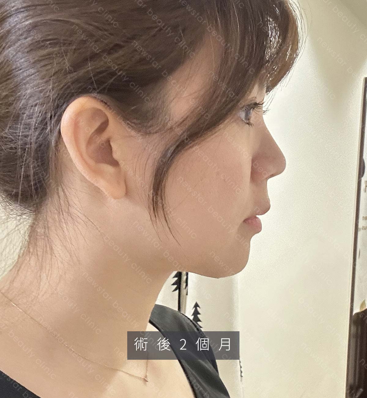 天鵝頸手術_術後生活恢復_2月jpg