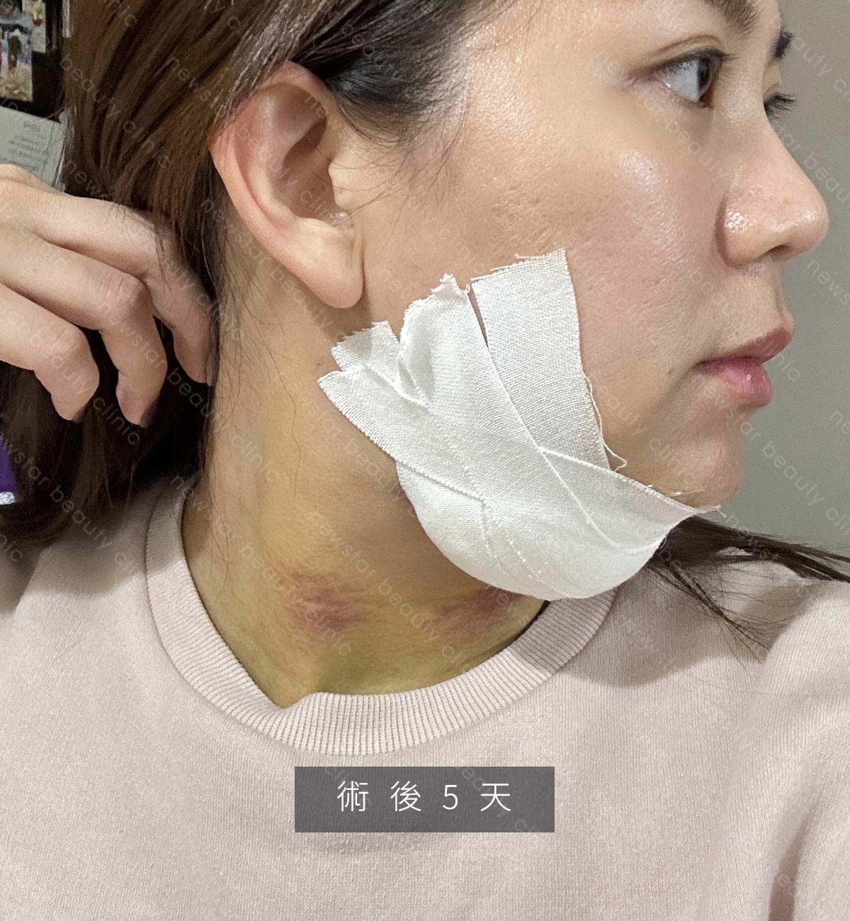 天鵝頸手術_術後生活恢復_5天