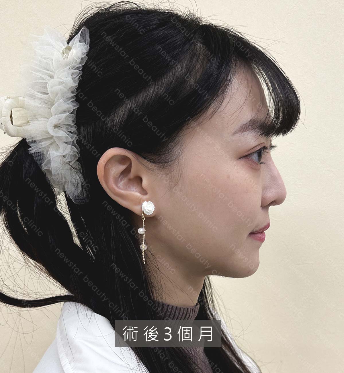 天鵝頸_kol_衣喬_術後3個月