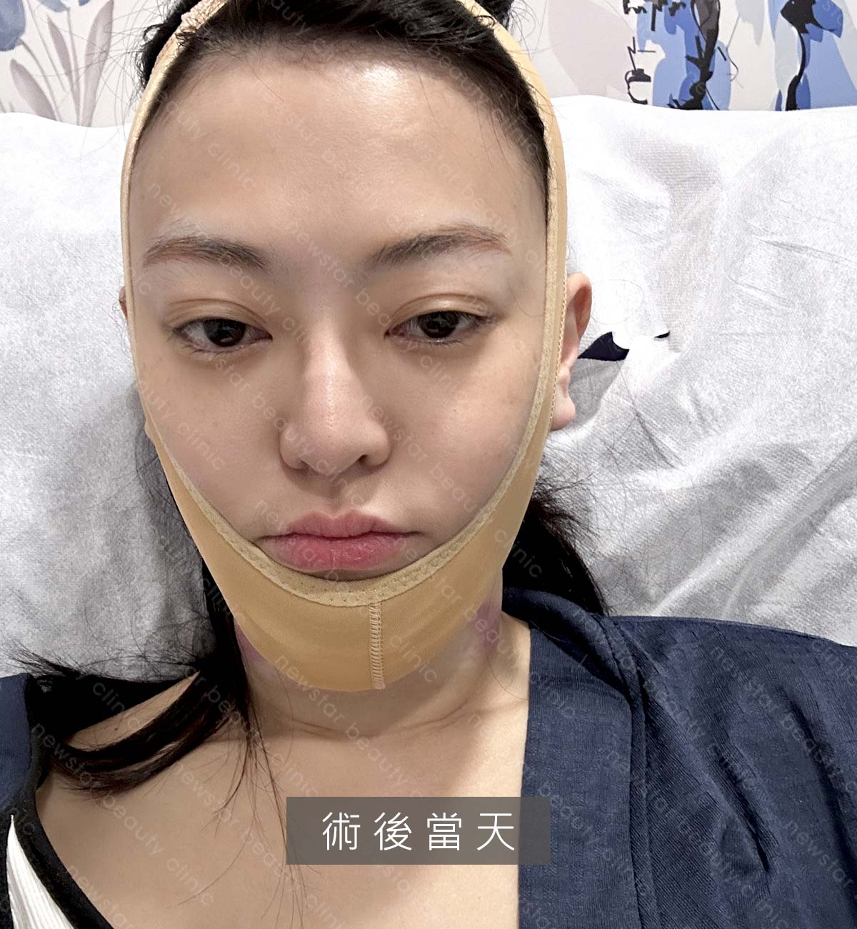 天鵝頸_kol_衣喬_術後當天
