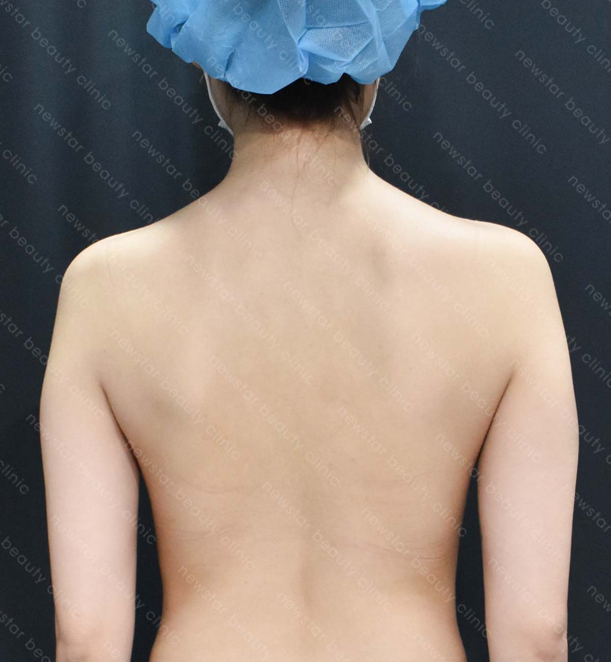 手臂抽脂術後_側面_before