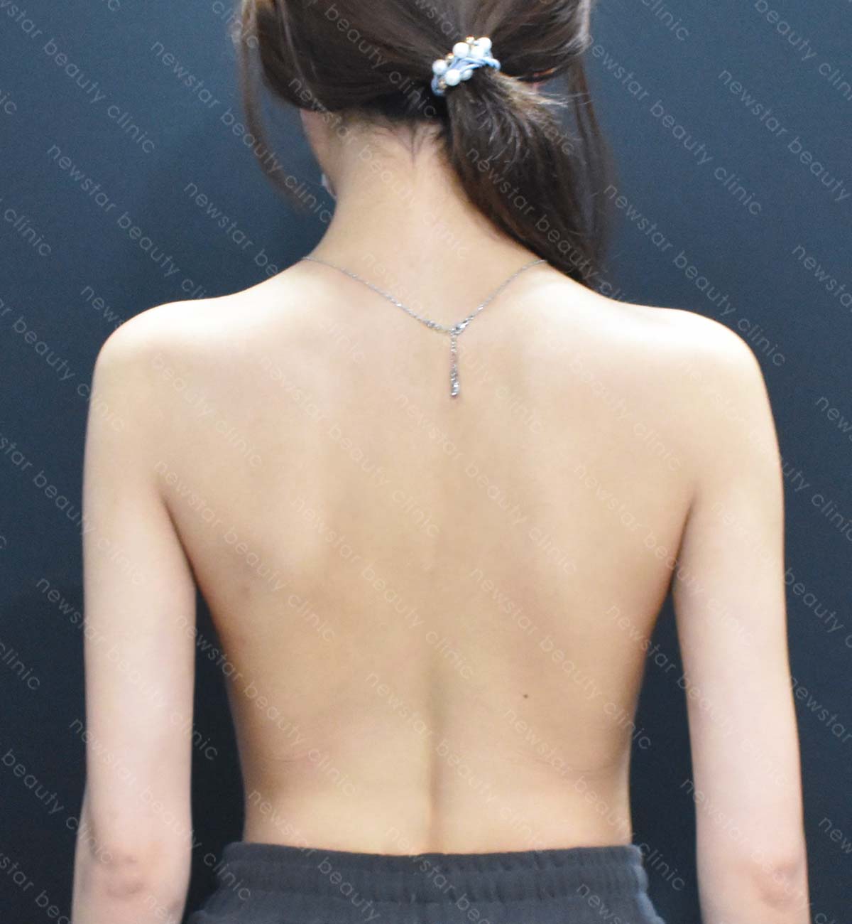 手臂抽脂術後_側面_after