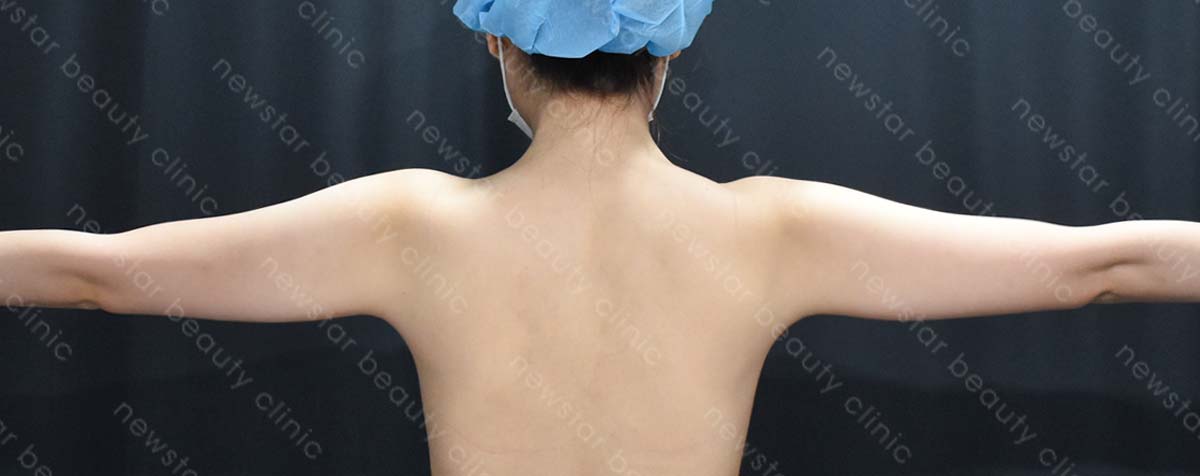 手臂抽脂術後_正側_before