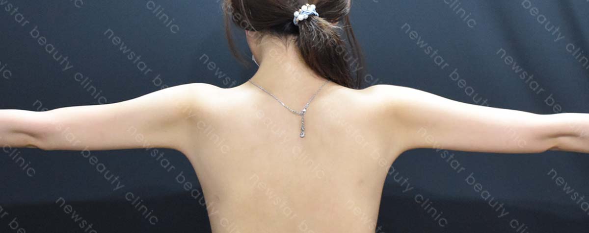 手臂抽脂術後_正側_after