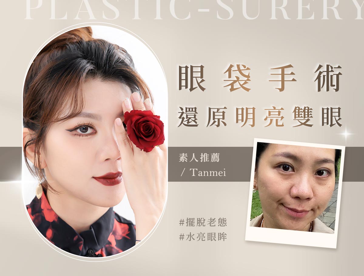 手術官網案例_外bn_潭美_眼袋