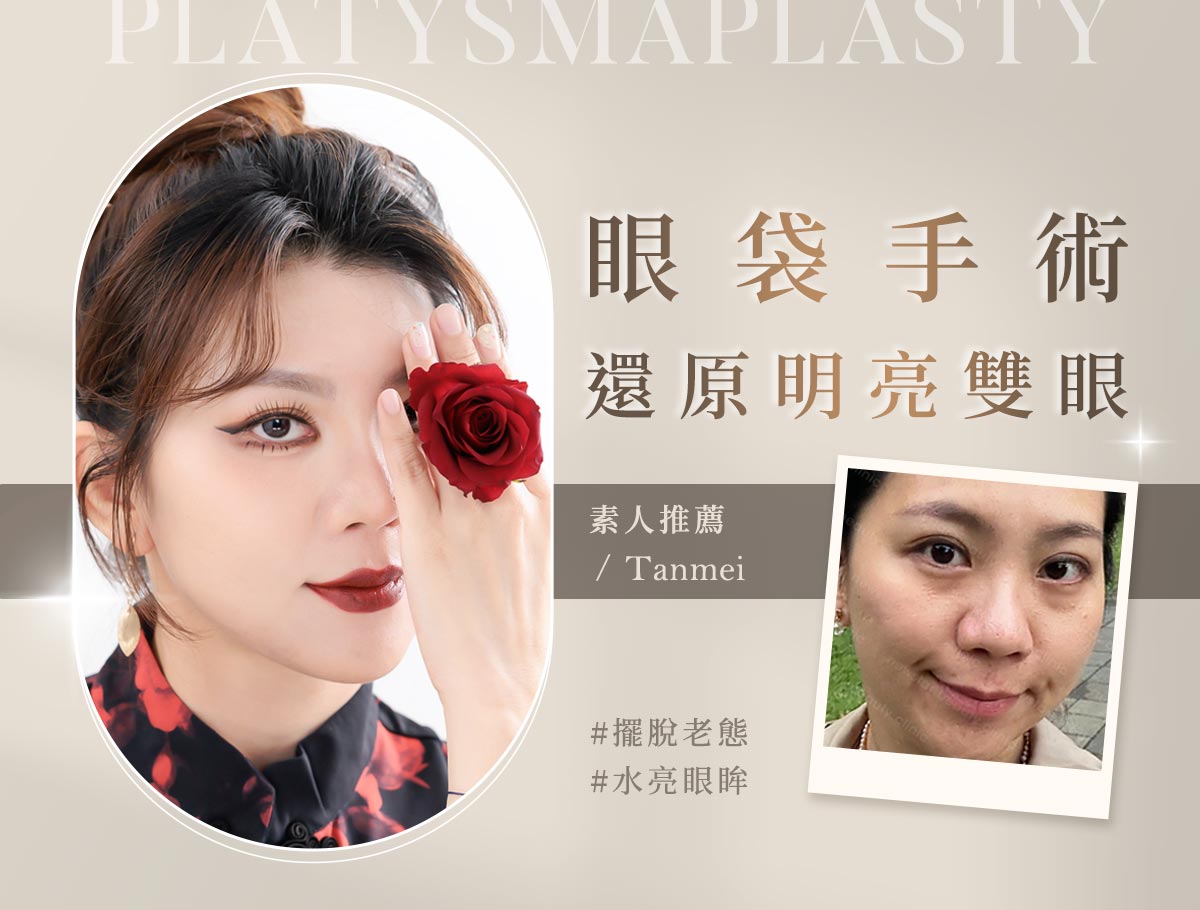 手術官網案例_外bn_潭美_眼袋