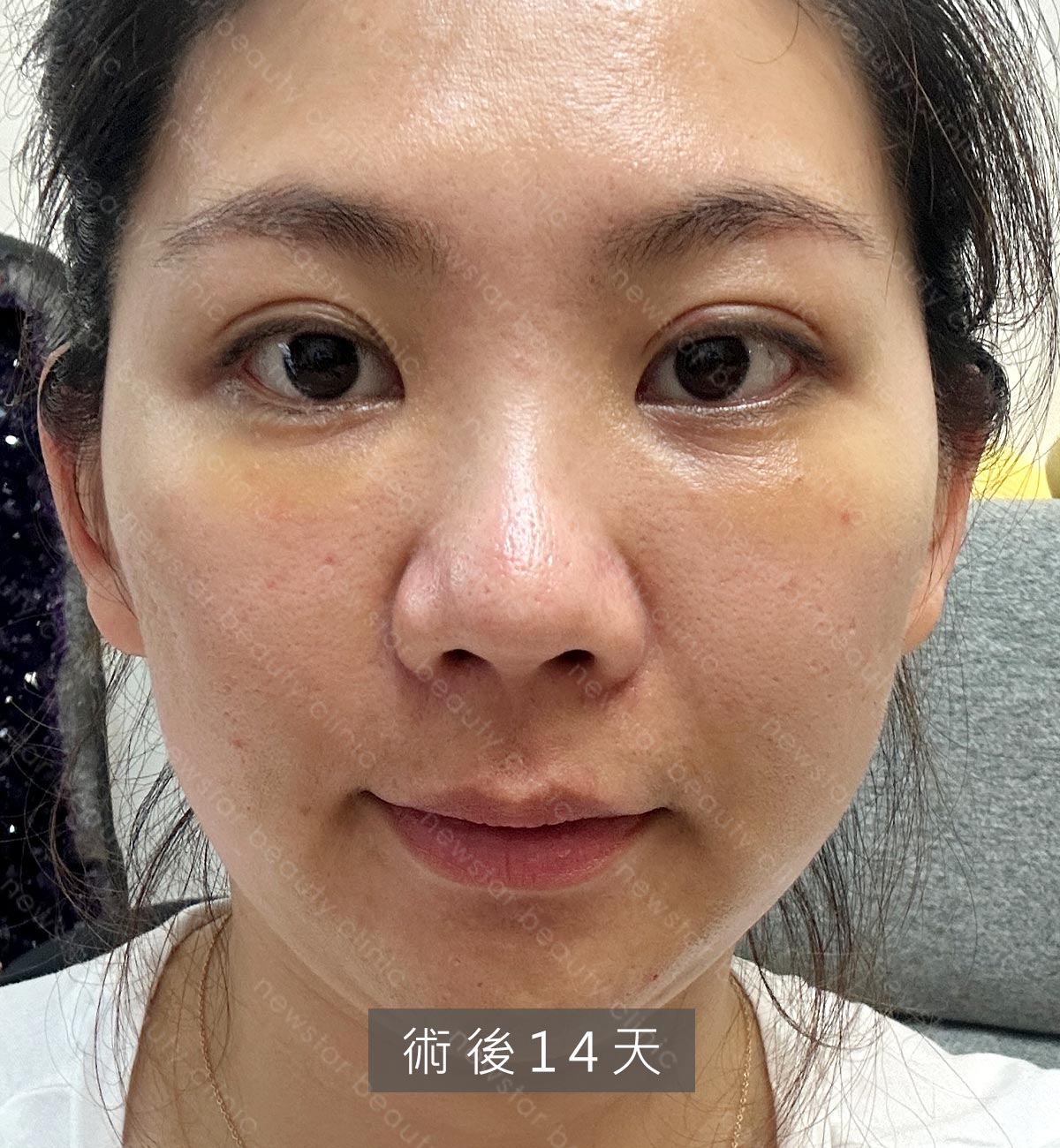 眼袋手術_術後第14天