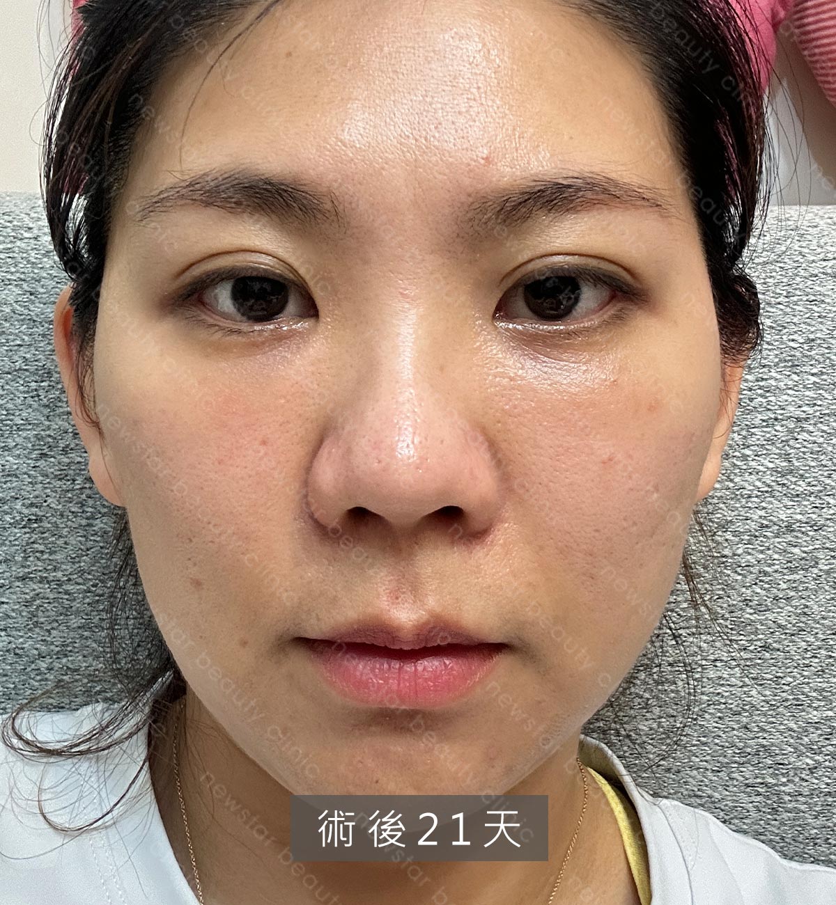 眼袋手術_術後第21天