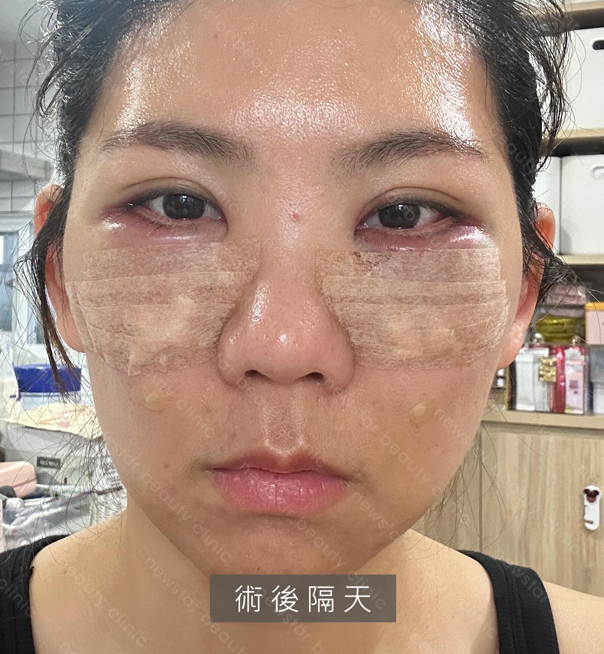 眼袋手術_術後第一天