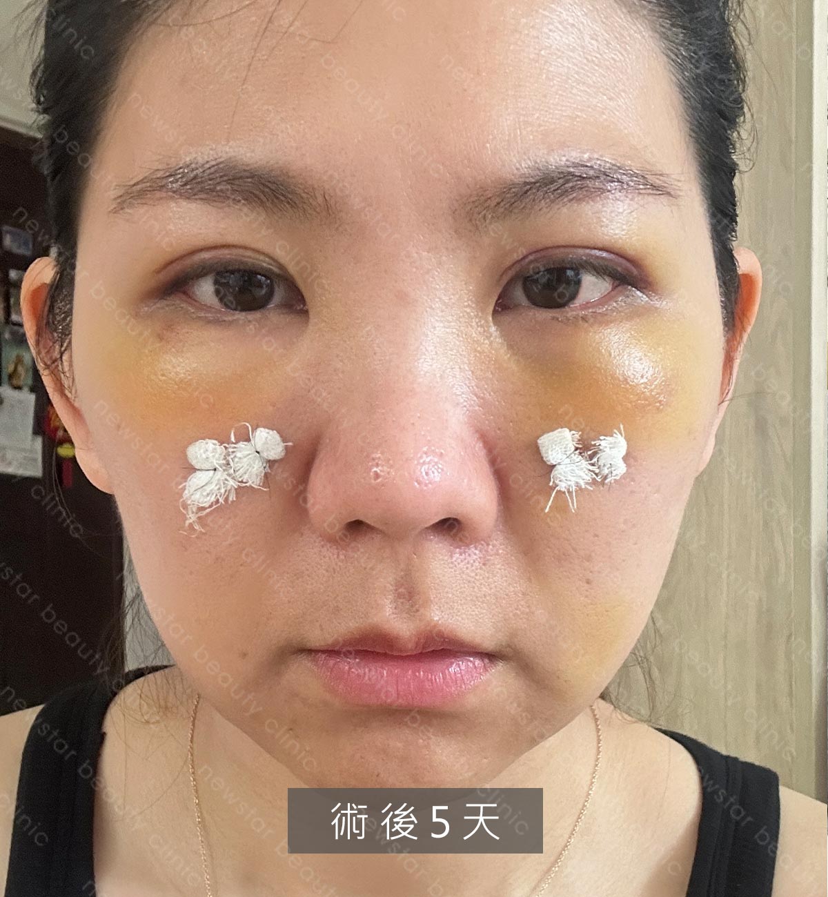 眼袋手術_術後第五天