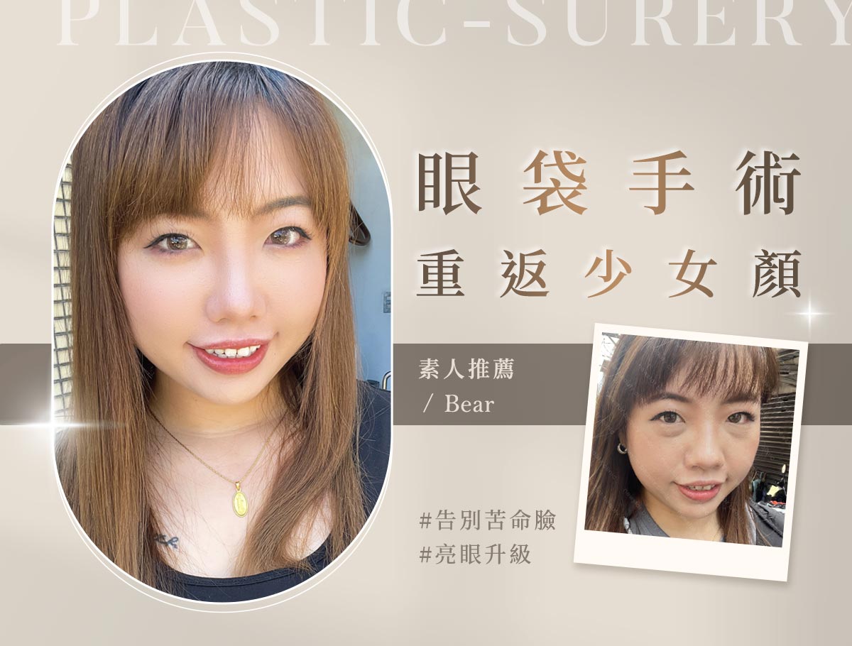 手術官網案例_外bn_貝貝_眼袋