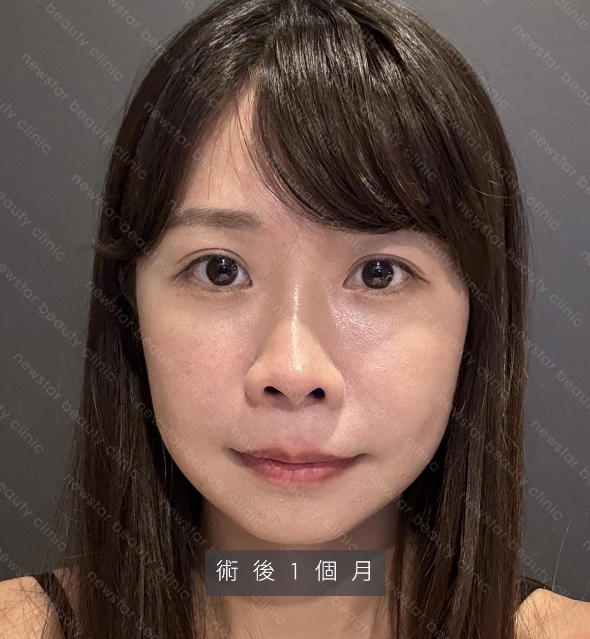 眼袋手術_術後1個月