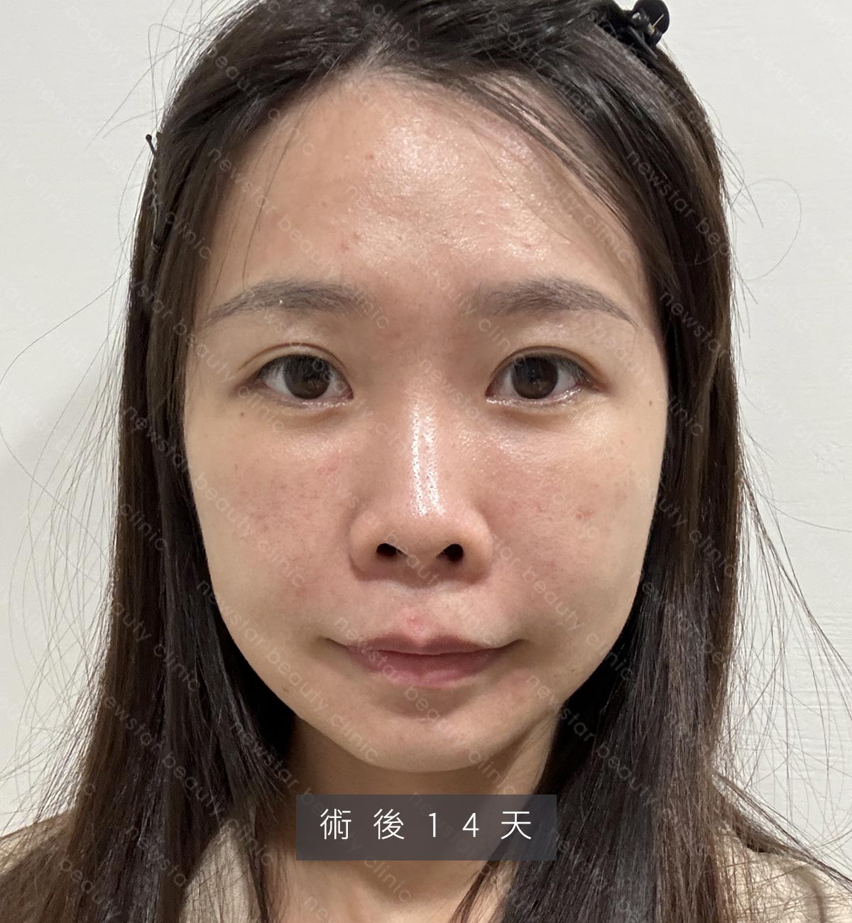 眼袋手術_術後恢復14天